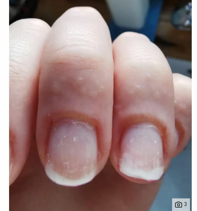 allergic reaction on their finger