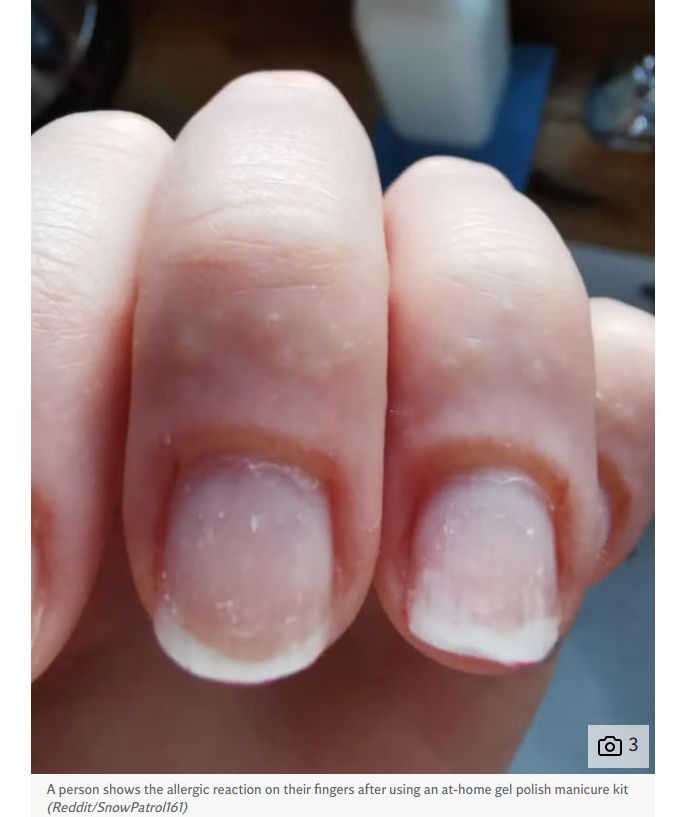 allergic reaction on their finger